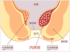 切れ痔といぼ痔の違いとは?画像付きで症状と対策を紹介大ぢ典ヒサヤ